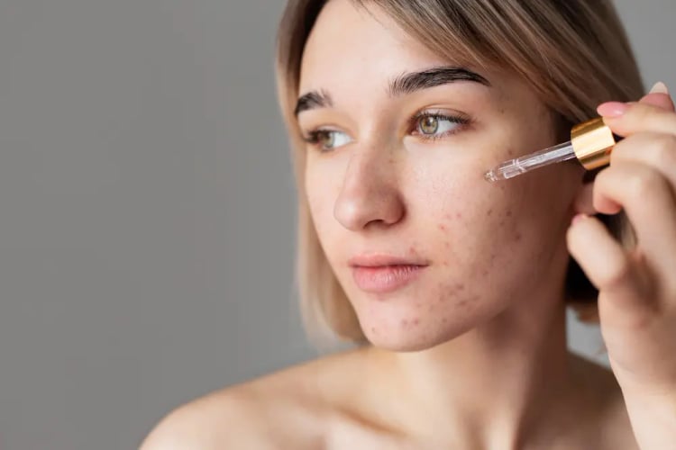 Αντιμετώπιση Ακμής Serum